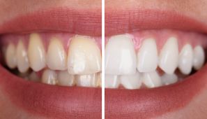 Facetas e lentes em resina composta
