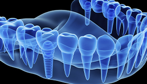 Curso de Implantodontia